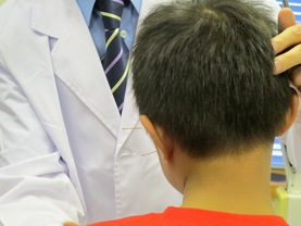 中醫師示範為兒童自閉症患者施針。